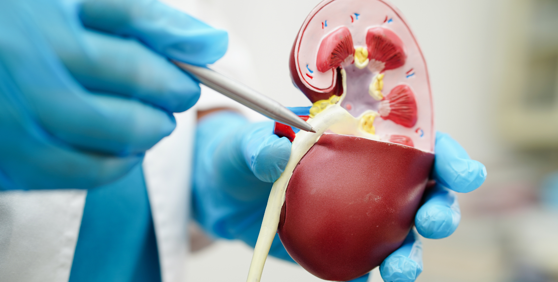 Cracking the Code on Kidney Stones: From Agony to Relief