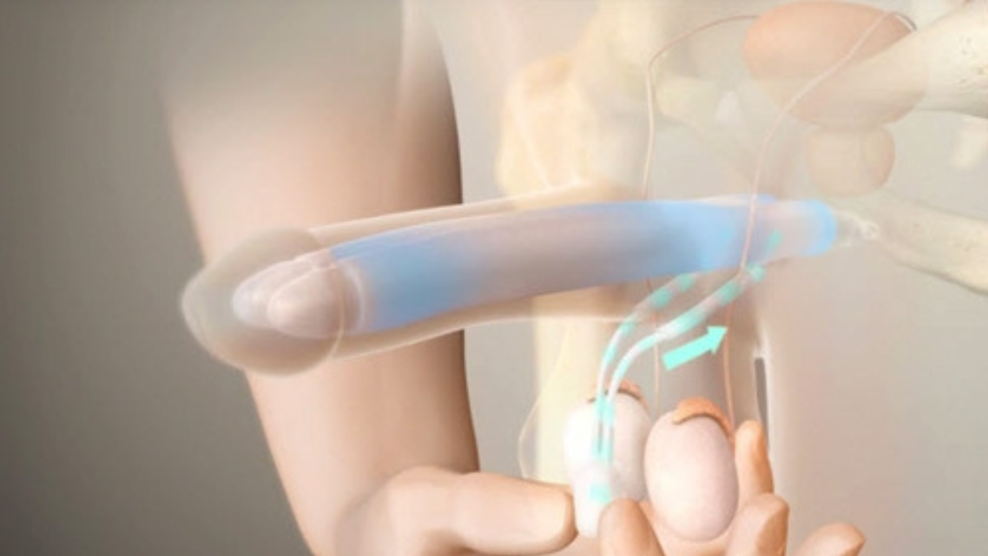 Penile Implant Surgery: The Permanent Solution for Erectile Dysfunction in Bhubaneswar