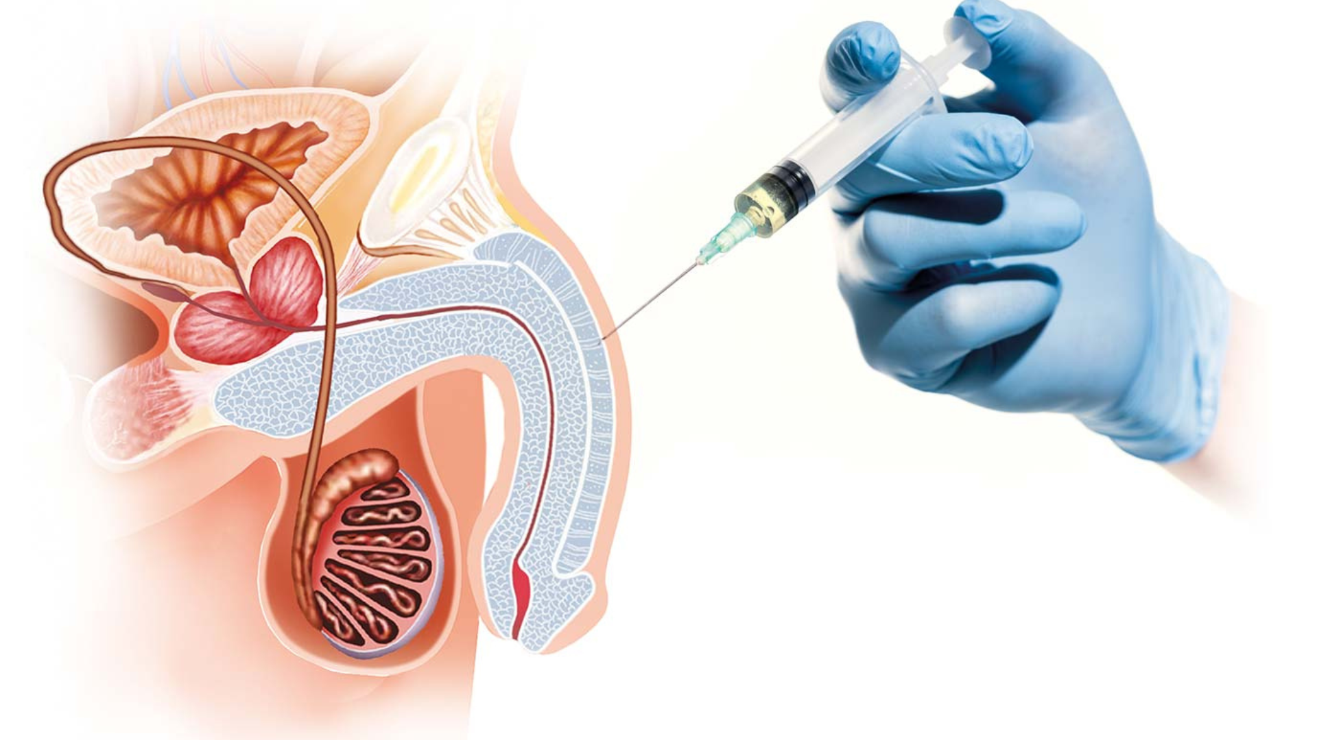 PRP Therapy or P Shot : New Secret to Erectile DysfunctionTreatment in Bhubaneswar