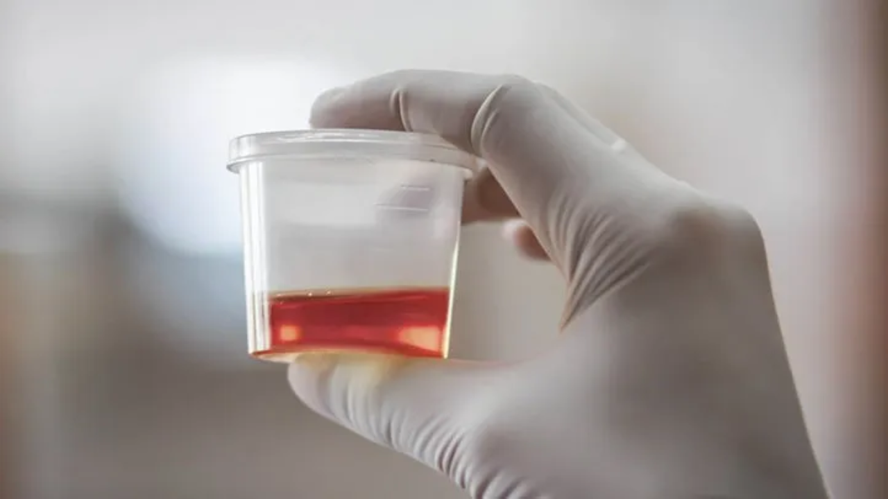 Common Causes of Blood in Urine
