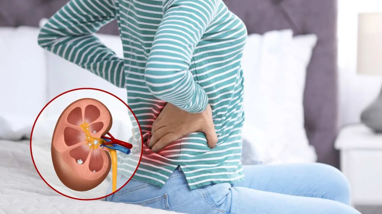 Kidney Stones: Symptoms, Causes, Treatment & Prevention