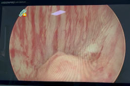 high bladder neck cystoscopic image