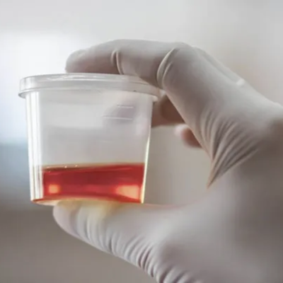 Common Causes of Blood in Urine