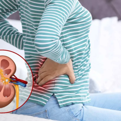 Kidney Stones: Symptoms, Causes, Treatment & Prevention