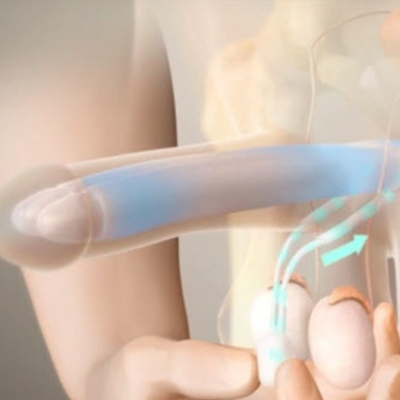 Penile Implant Surgery: The Permanent Solution for Erectile Dysfunction in Bhubaneswar