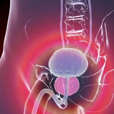 What is BPH? A Complete Guide to Enlarged Prostate