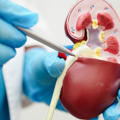 Cracking the Code on Kidney Stones: From Agony to Relief